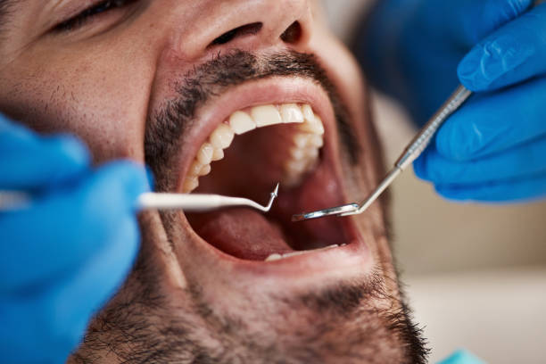 Best Emergency Dental Care for Broken or Chipped Teeth in Lewisburg, PA