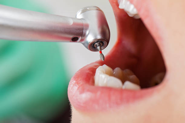 Best Emergency Dental Care for Broken or Chipped Teeth in Lewisburg, PA
